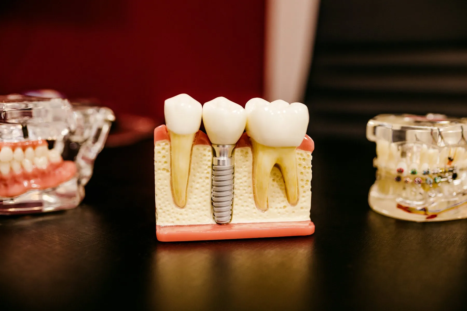 A dental model showing a tooth implant and crowns
